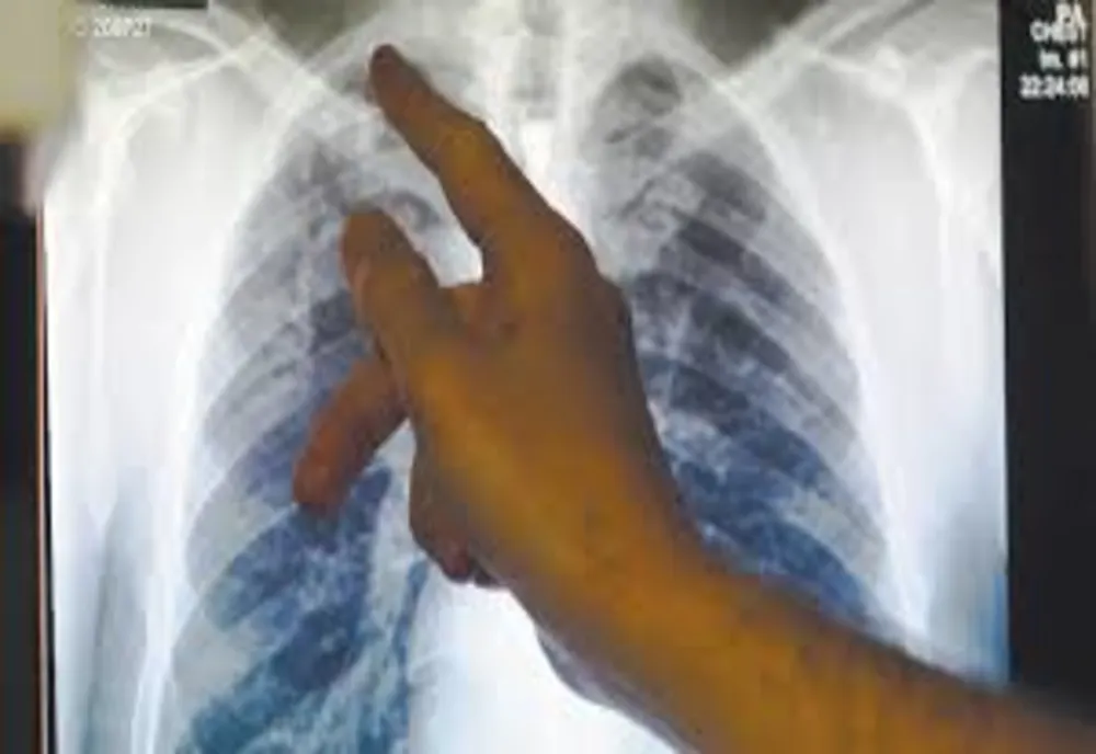 CAZURI DE TUBERCULOZĂ MULTIDROG REZISTENTĂ, APĂRUTE LA PACIENȚI CARE AU CONTRACTAT BOALA ÎN STRĂINĂTATE