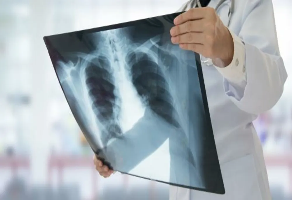 Campanie de depistare a tuberculozei în zece localități din Timiș