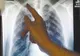 CAZURI DE TUBERCULOZĂ MULTIDROG REZISTENTĂ, APĂRUTE LA PACIENȚI CARE AU CONTRACTAT BOALA ÎN STRĂINĂTATE